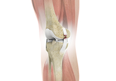Ligament Injuries